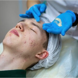 rutina facial para tratar el acne