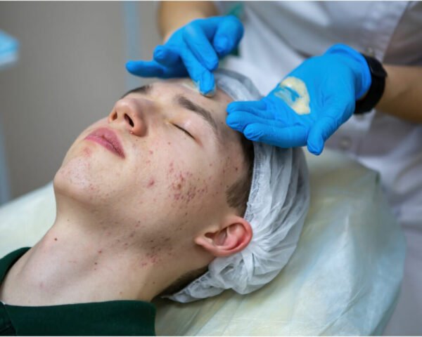 rutina facial para tratar el acne